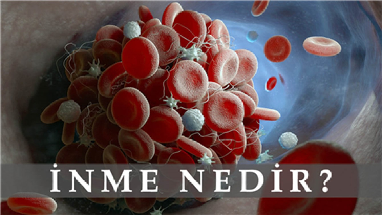 İNME NEDİR? NEDEN KAYNAKLANIR?