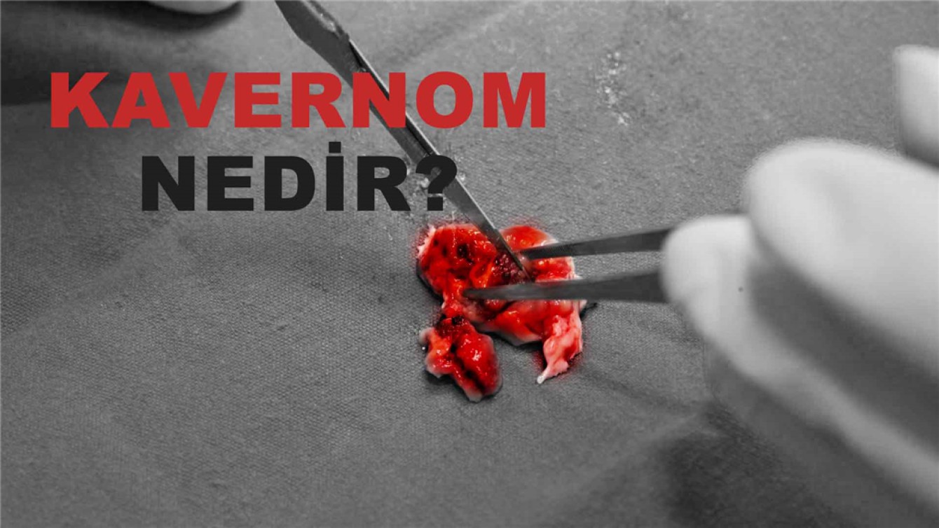 KAVERNOM NEDİR?