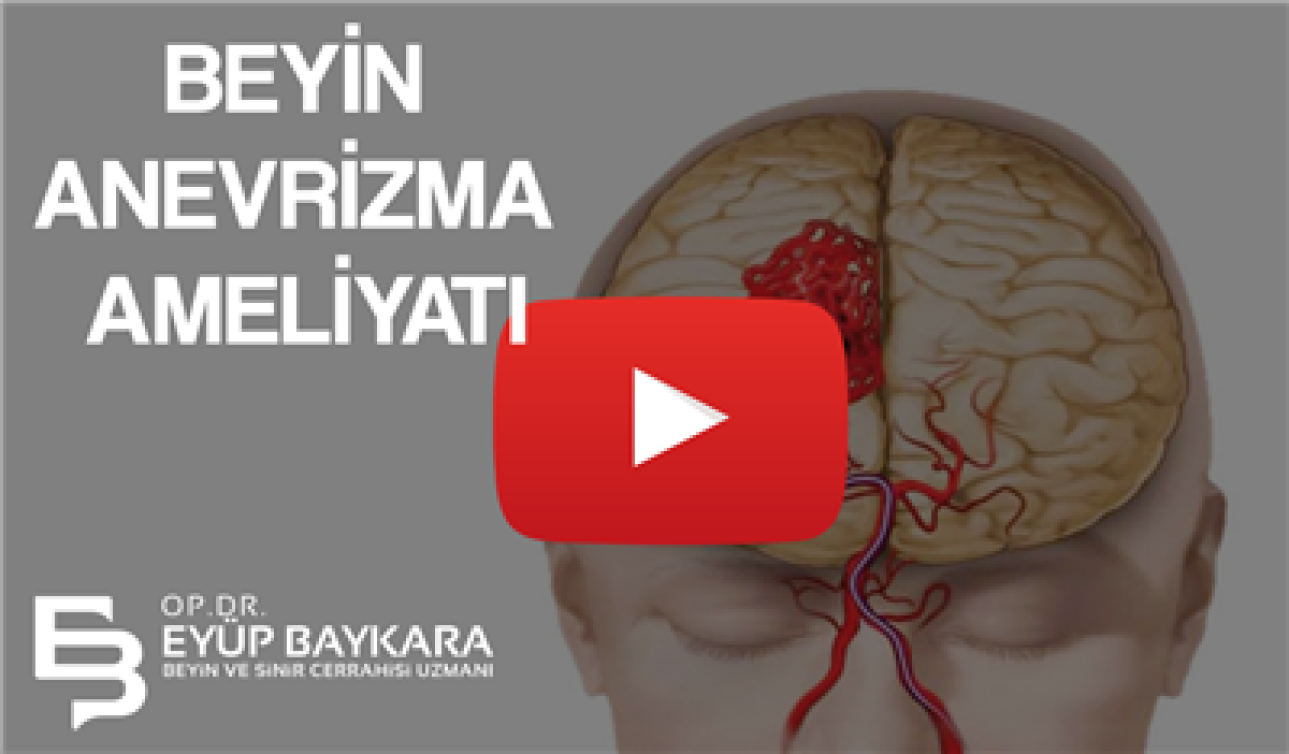 BEYİN ANEVRİZMA AMELİYATI
