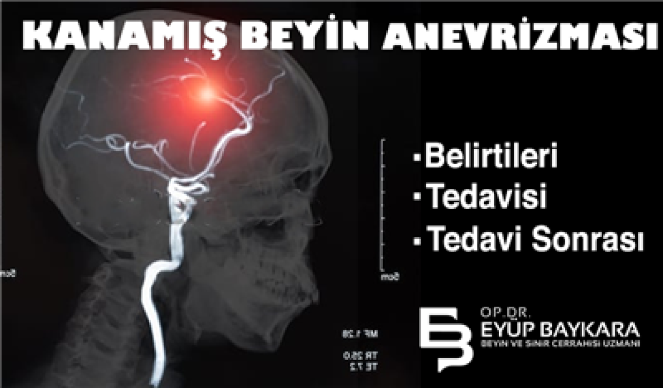 KANAMIŞ BEYİN ANEVRİZMASI