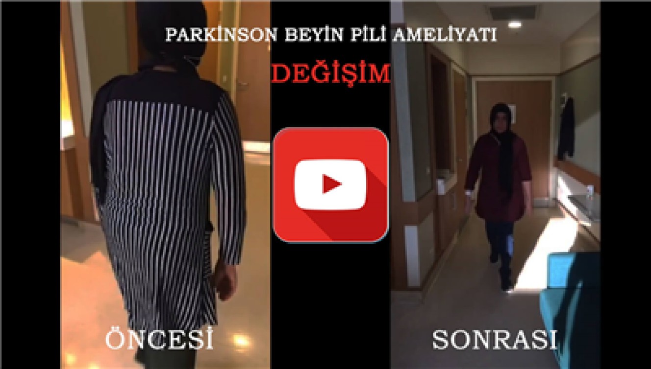 PARKİNSON BEYİN PİLİ AMELİYATI SONRASI DEĞİŞİM