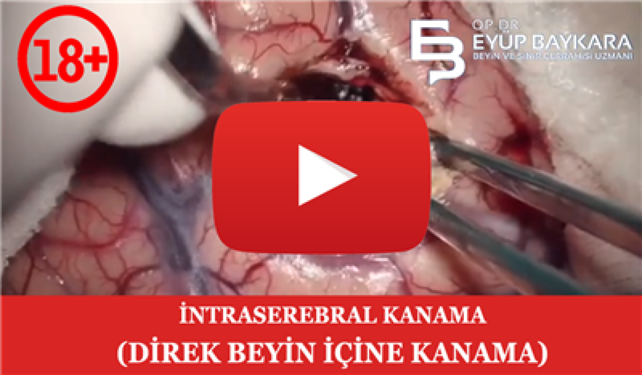 İNTRASEREBRAL KANAMA