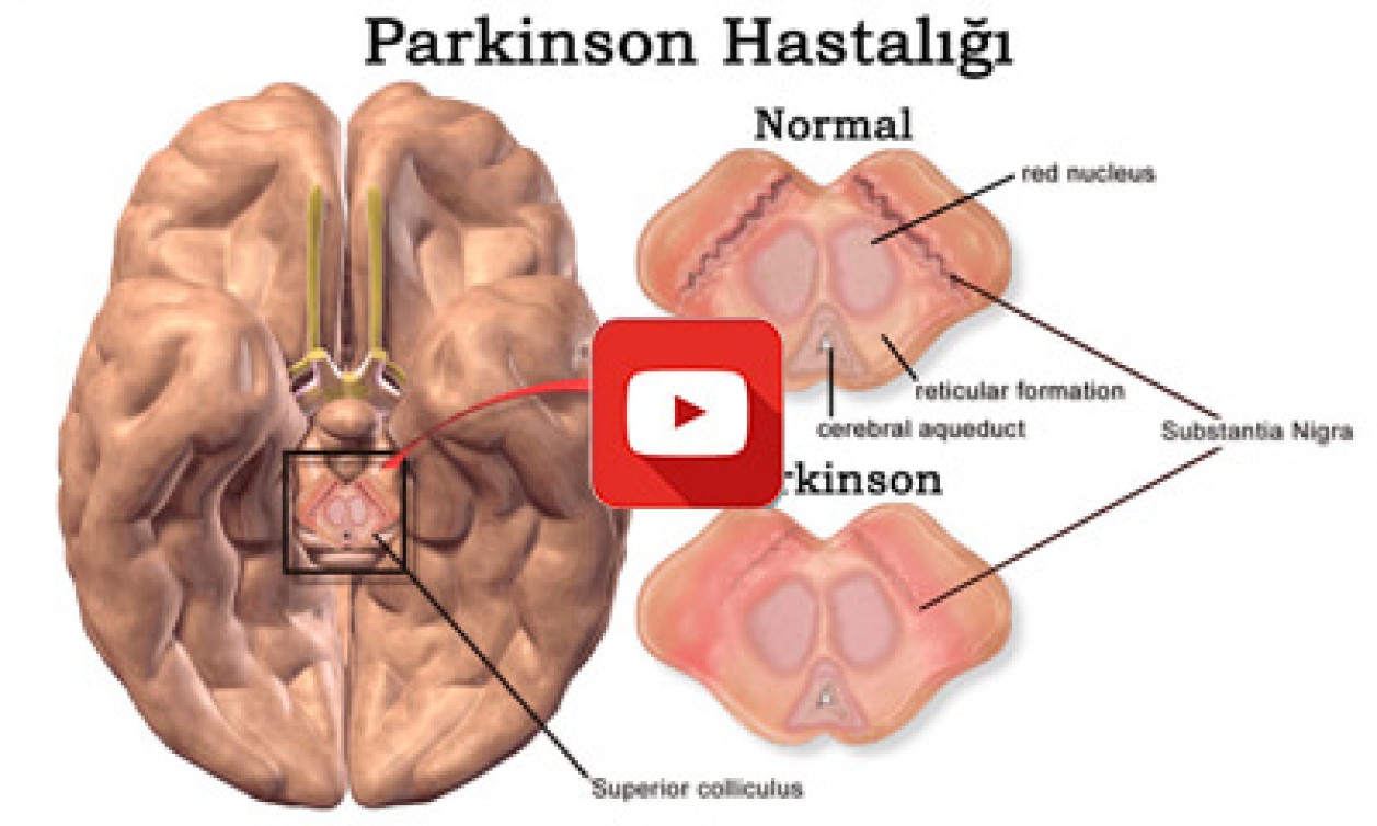 PARKİNSON BEYİN PİLİ