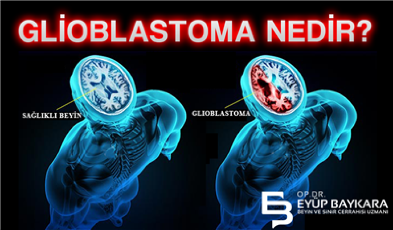 GLİOBLASTOMA NEDİR ?
