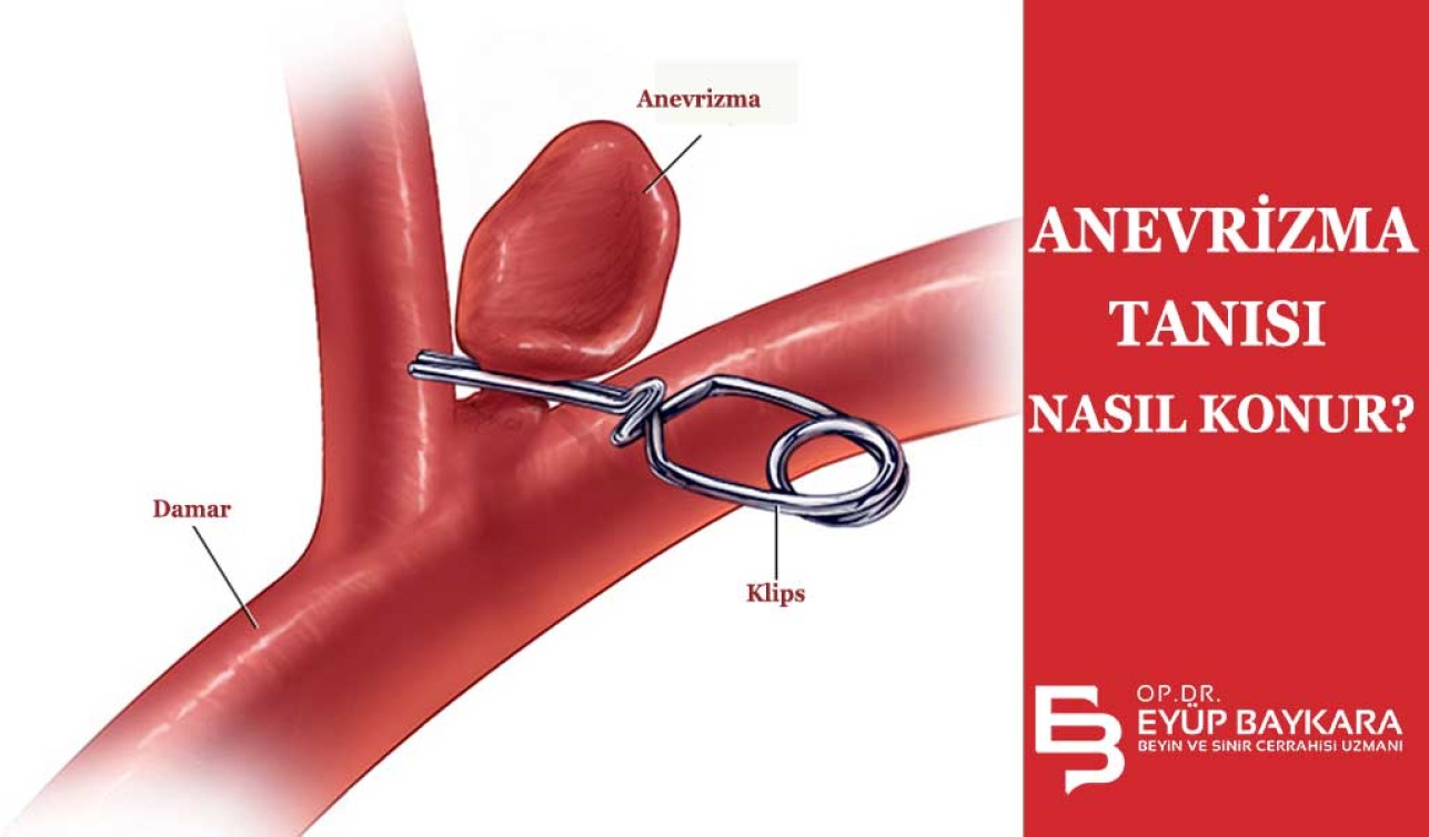 ANEVRİZMA TEŞHİSİ NASIL KONUR ?