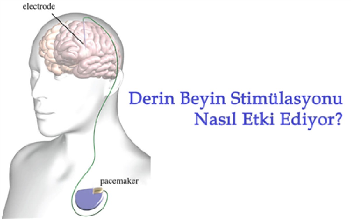 PARKİNSON DERİN BEYİN STİMÜLASYONU NASIL ETKİ EDİYOR?