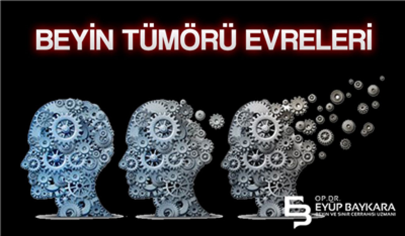 BEYİN TÜMÖRÜ EVRELERİ