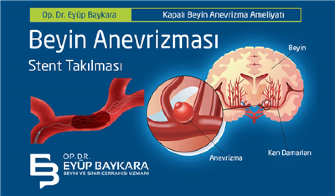 BEYİN ANEVRİZMASI STENT TAKILMASI
