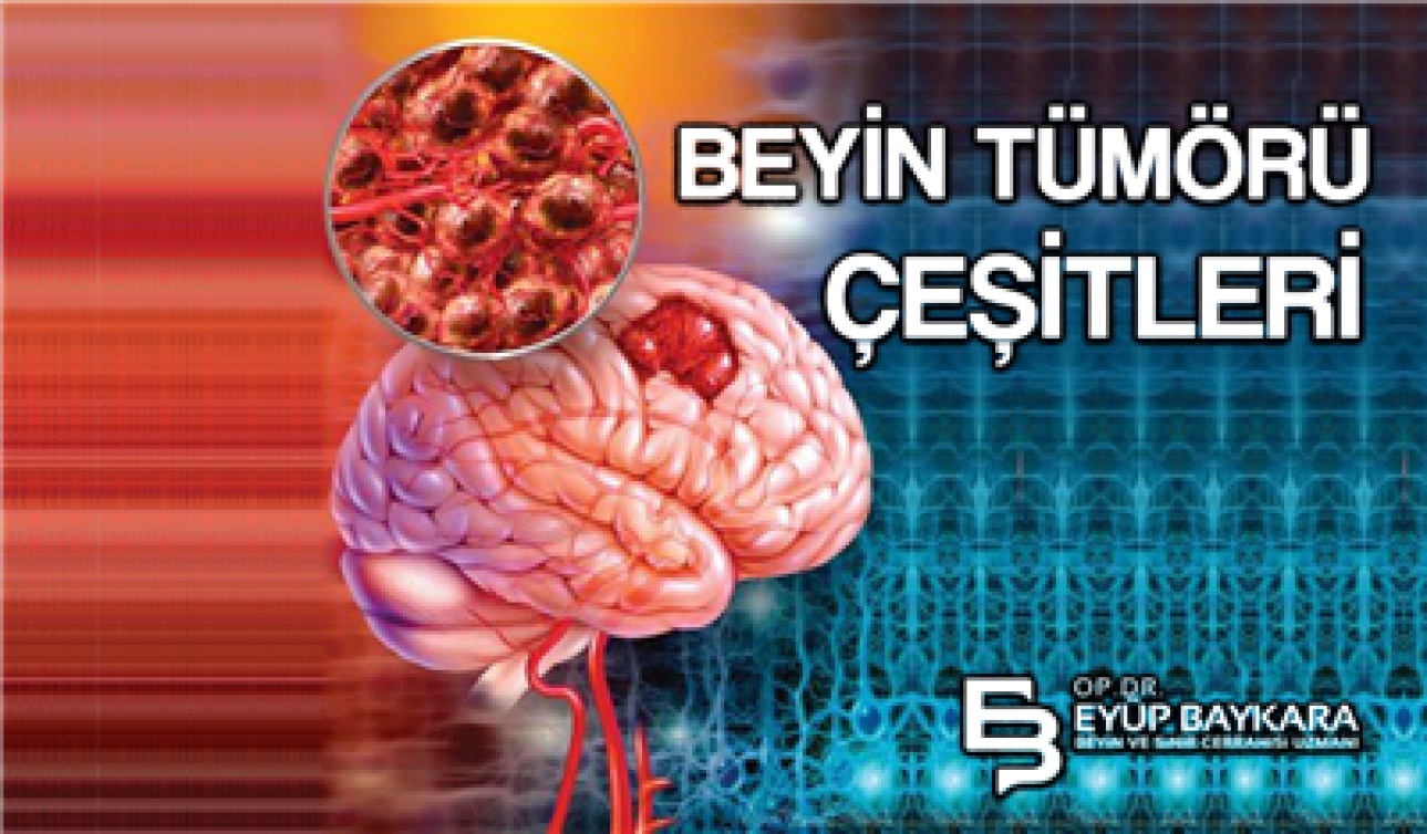 BEYİN TÜMÖRÜ ÇEŞİTLERİ