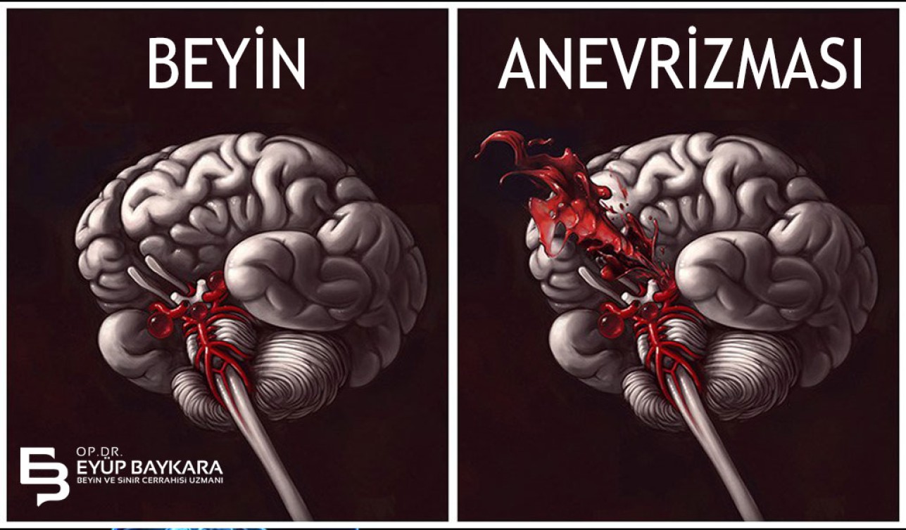 BEYİN DAMAR ANEVRİZMASI