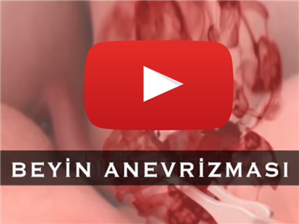 ANEVRİZMA CERRAHİSİ KLİP AŞAMASI VE SONRASI